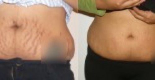 Product picture 6 Ways To Eliminate Stretch Marks